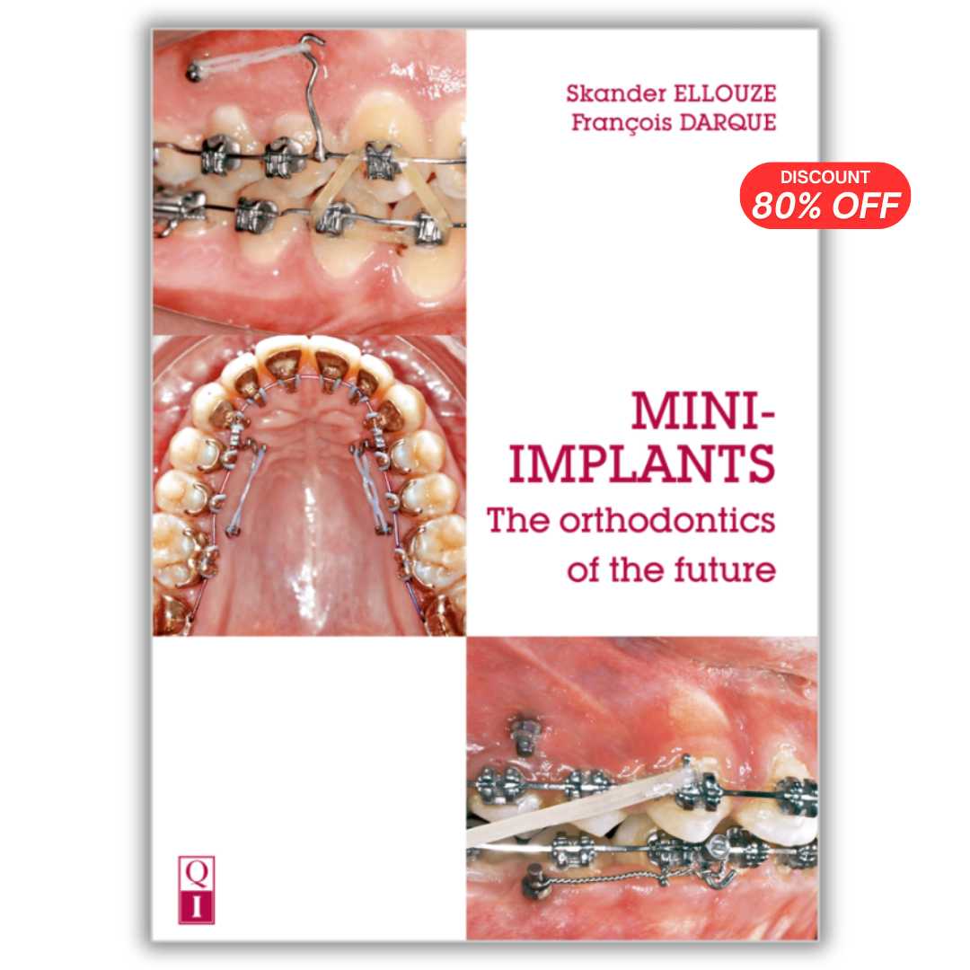 MINI-IMPLANTS: The Orthodontics of the Future (Scanned Copy)