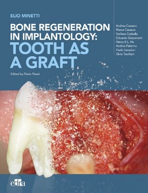 https://dentalmp4.com/wp-content/uploads/2023/08/Bone-regeneration-in-implantology_Tooth-as-a-Graft.jpg