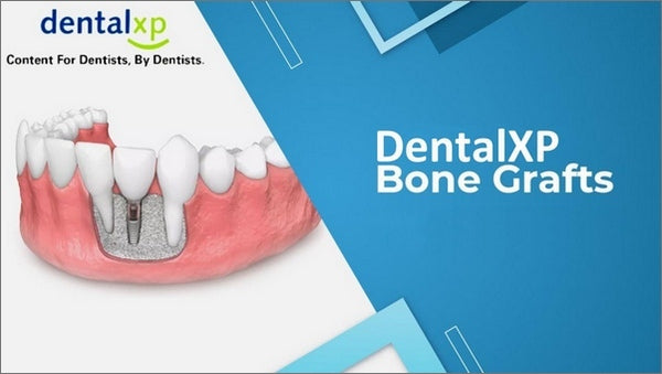 https://dentalmp4.com/wp-content/uploads/2023/07/DentalXP-Bone-Grafts.jpg