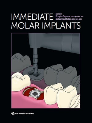 https://dentalmp4.com/wp-content/uploads/2023/03/Immediate-Molar-Implants.jpg
