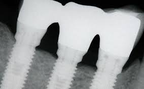 https://dentalmp4.com/wp-content/uploads/2022/06/Online-Residency-Program-A-Z-in-Implant-Dentistry.jpg