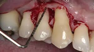https://dental-books.com/wp-content/uploads/2022/08/Single-Flap-Approach.jpg