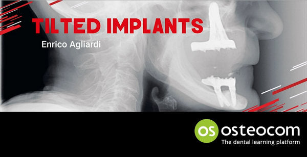 https://dentalmp4.com/wp-content/uploads/2022/12/Tilted-Implants.jpg