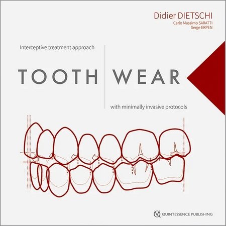 https://dentalmp4.com/wp-content/uploads/2023/08/Tooth-Wear-Interceptive-Treatment-Approach-with-Minimally-Invasive-Protocols.jpg