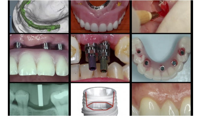 https://dentalmp4.com/wp-content/uploads/2022/07/A-Z-in-Restorative-Implant-Dentistry-Series.jpg