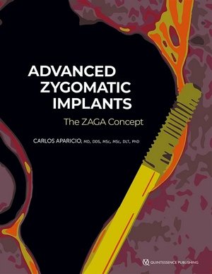https://dentalmp4.com/wp-content/uploads/2023/11/Advanced-Zygomatic-Implants.jpg
