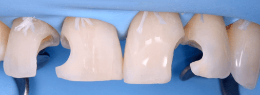 https://dentalmp4.com/wp-content/uploads/2022/07/Direct-and-Indirect-Adhesive-Restorations.png