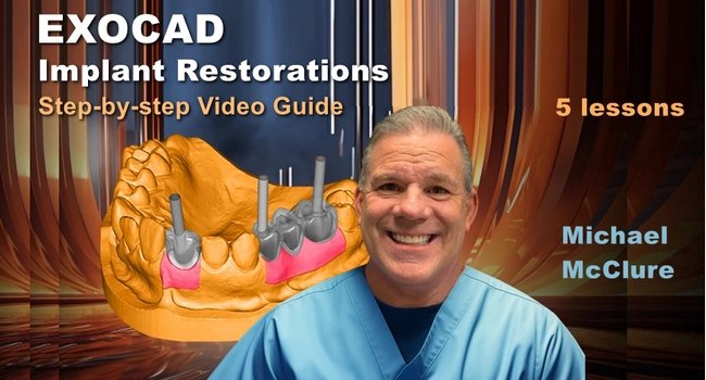 https://dentalmp4.com/wp-content/uploads/2023/08/EXOCAD-Implant-Restorations.jpg
