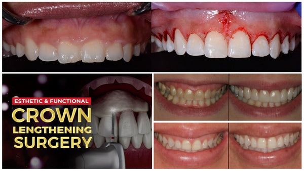 https://dental-books.com/wp-content/uploads/2023/12/Esthetic-and-Functional-Crown-Lengthening.jpg