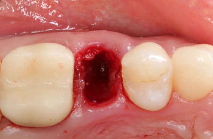 https://dentalmp4.com/wp-content/uploads/2022/07/Extraction-Socket.jpg