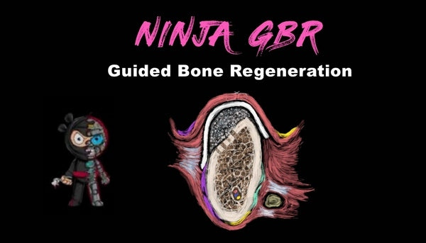 https://dentalmp4.com/wp-content/uploads/2023/04/Implant-Ninja-Guided-Bone-Regeneration.jpg