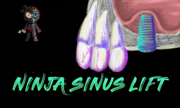 https://dentalmp4.com/wp-content/uploads/2023/09/Ninja-Sinus-Lift.jpg