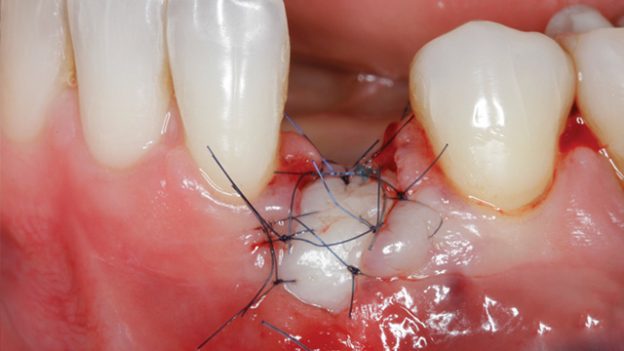 https://dentalmp4.com/wp-content/uploads/2022/08/Soft-Tissue-Management-around-Natural-Teeth-and-Dental-Implants.jpg