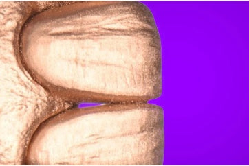 https://dentalmp4.com/wp-content/uploads/2022/06/Vertical-preparation-protocols-1.jpg