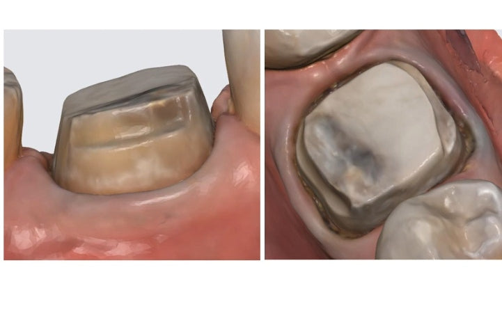 https://dentalmp4.com/wp-content/uploads/2022/06/Vertical-preparation-protocols-3.jpg