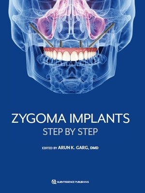 https://dentalmp4.com/wp-content/uploads/2023/05/Zygoma-Implants-Step-by-Step.jpg