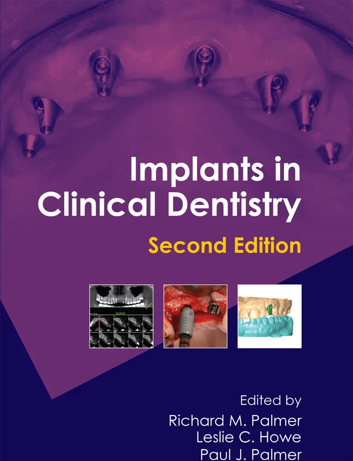 Implants in Clinical Dentistry, 2nd Edition